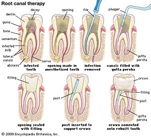 root canal pittsburgh