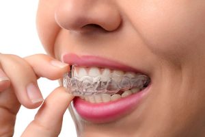 best invisalign doctor in cranberry township