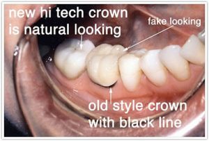 crown surgery